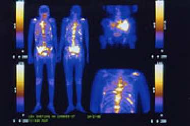 Pruebas genéticas permiten tratamiento preciso y dirigido en cáncer
