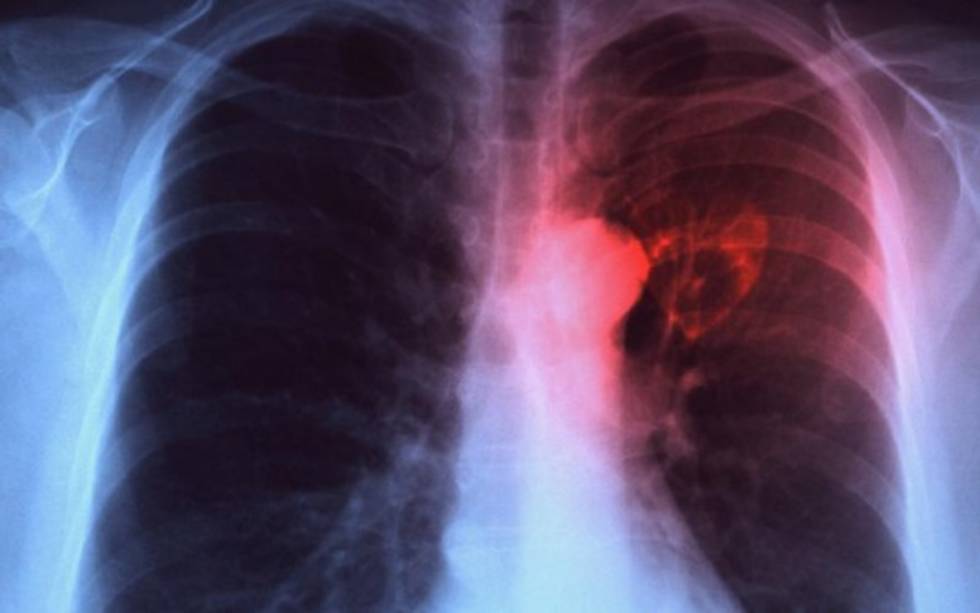 Tuberculosos asociada en el 40 por ciento de las muertes de personas con sida: AHF México