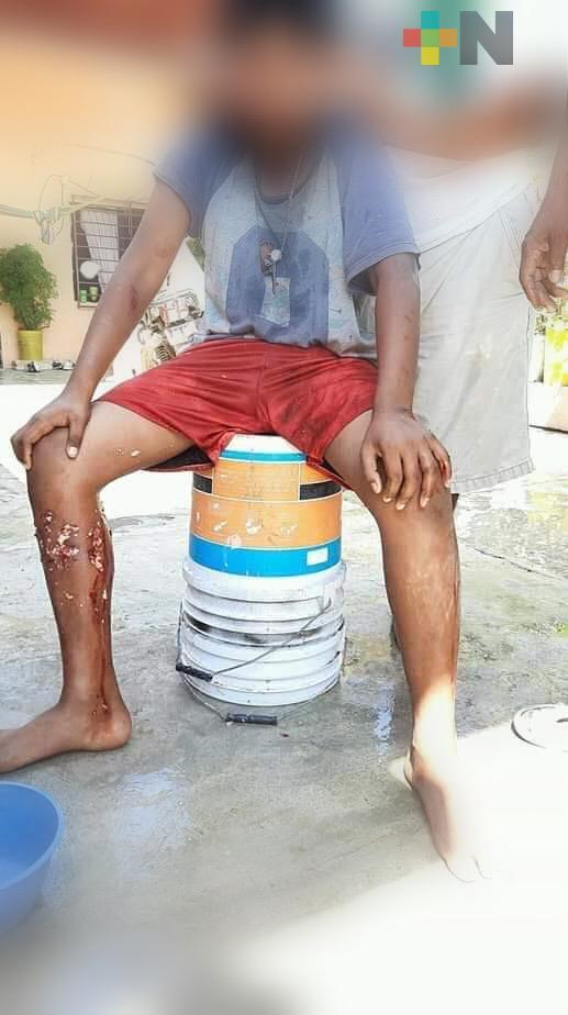 Menor lesionado por mordedura de perro en Coatzacoalcos