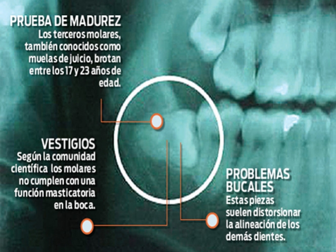 Calor provoca las muelas del juicio, dolor e inflamación primeras molestias