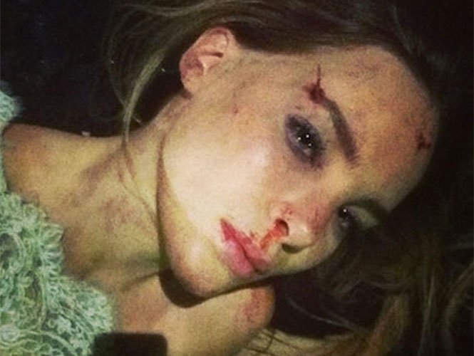 Belinda difunde su ‘accidente’