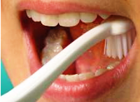 Veracruz con graves problemas de caries