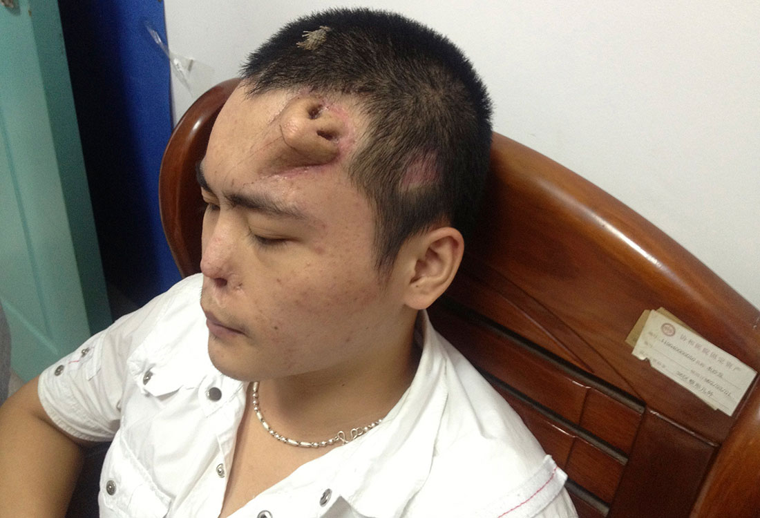 ‘Crece’ nariz en la frente de un joven en China