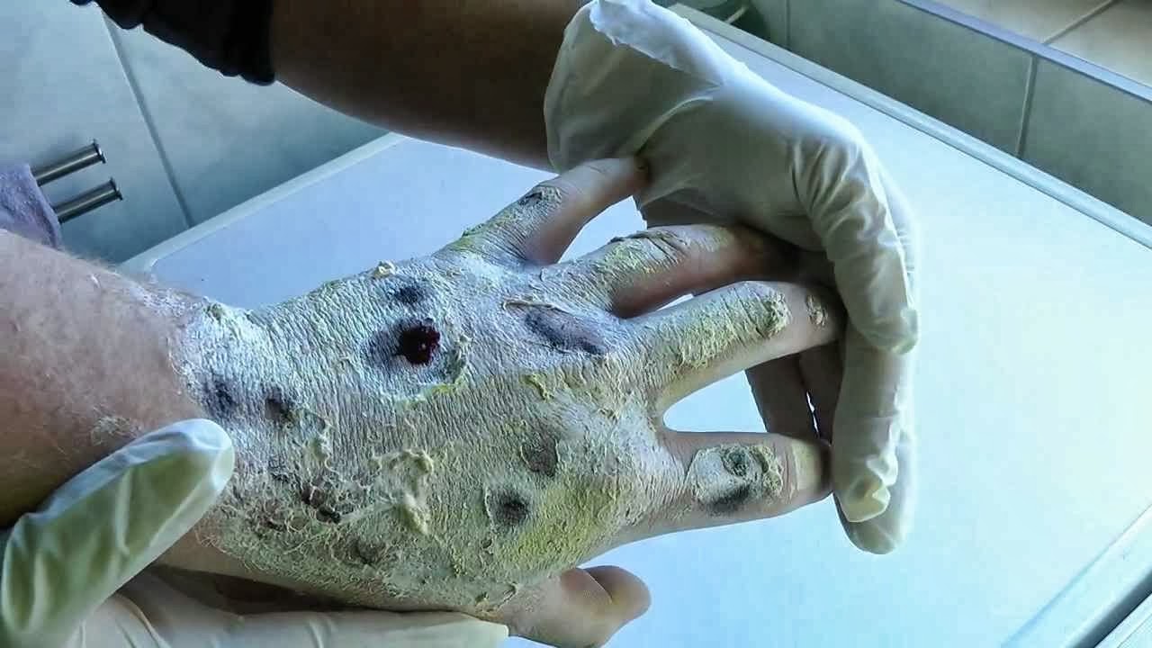 Alerta por ‘Krokodil’, la droga devoradora de adictos