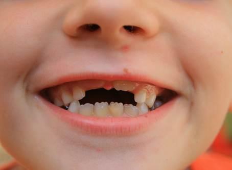 Con caries, cuatro de cada diez niños en Boca del Río