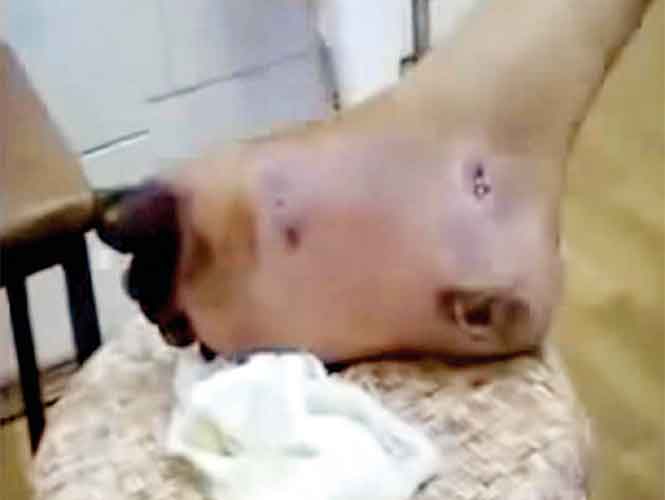 La Ssa, en alerta por droga Krokodil; confirman un caso en Puerto Vallarta