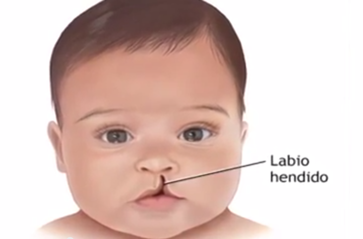 Se realizará la décima jornada de cirugías de labio leporino y paladar hendido en Coatzacoalcos