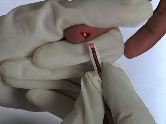Un aparato japonés detecta diversos cánceres con gota de sangre