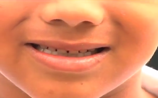 Rechinan los dientes el 80 por ciento de los mexicanos