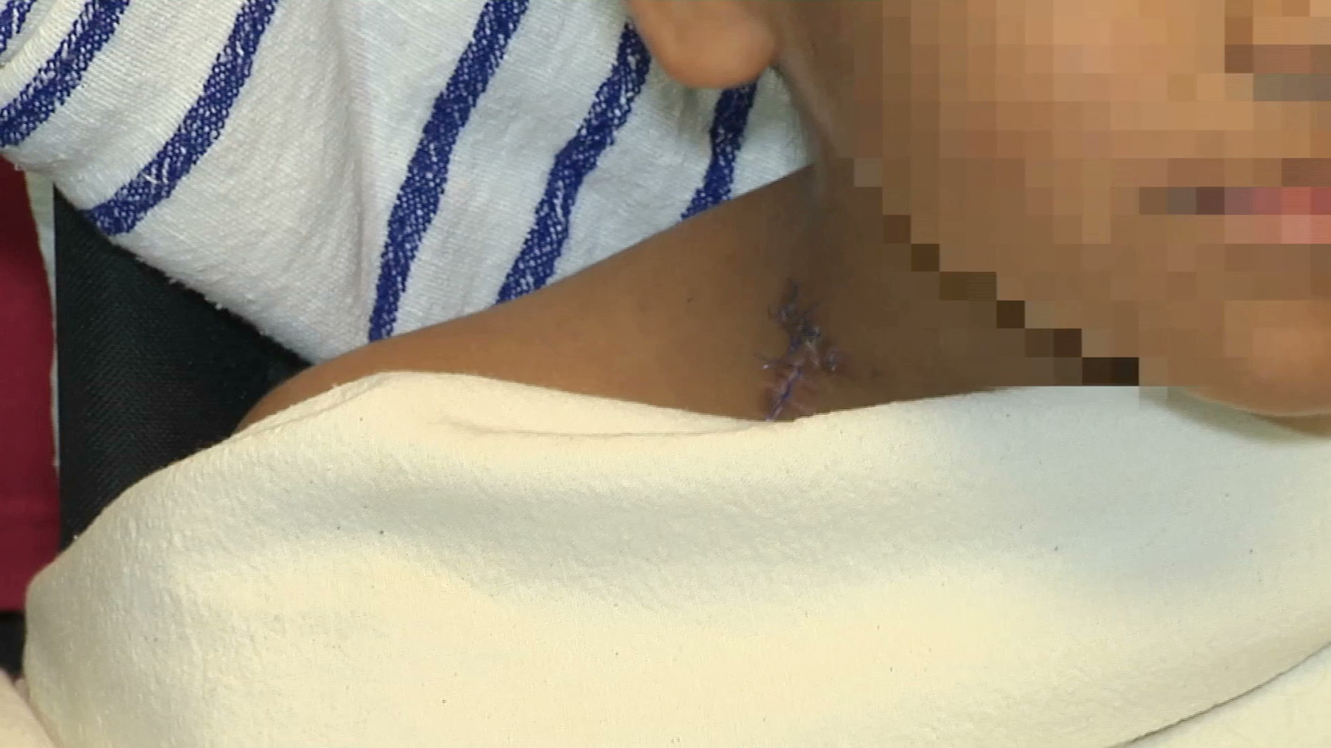 Médicos salvan brazo de niño con desprendimiento de vasos sanguíneos