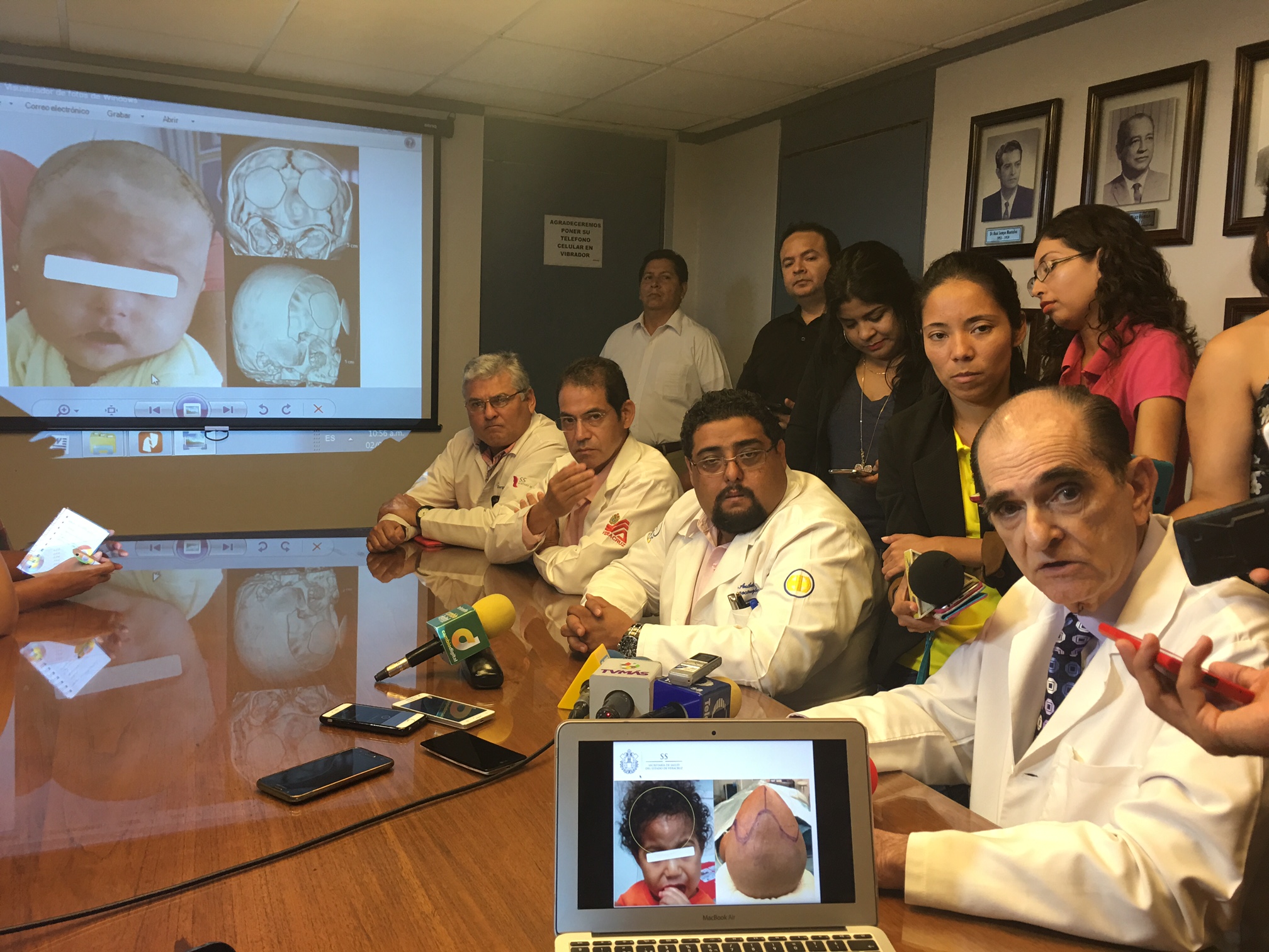 Realizan médicos del HAEV exitosa remodelación craneal en niños veracruzanos