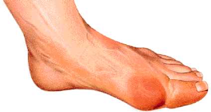 Gota, enfermedad crónica que afecta a tres por ciento de los mexicanos