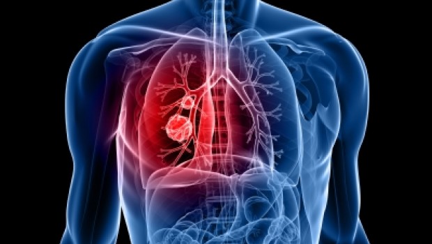 Conmemoran en México primer Día nacional de cáncer del pulmón