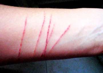 DIF Coatzacoalcos detecta casos de «cutting» en escuelas secundarias