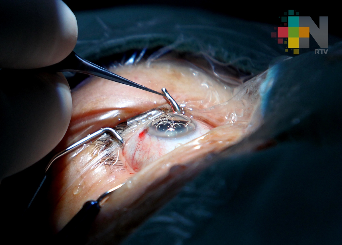 Habitantes de Martínez de la Torre aprovechan cirugías gratuitas de catarata