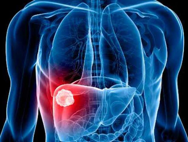 Alerta IMSS peligros de acumulación de grasa en hígado, puede causar cirrosis e incluso cáncer