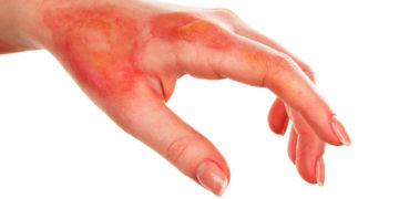 Desarrollan en la UNAM nuevos materiales para cicatrización de heridas por quemaduras