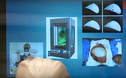Clonan senos con tecnología 3D para mujeres con cáncer de mama