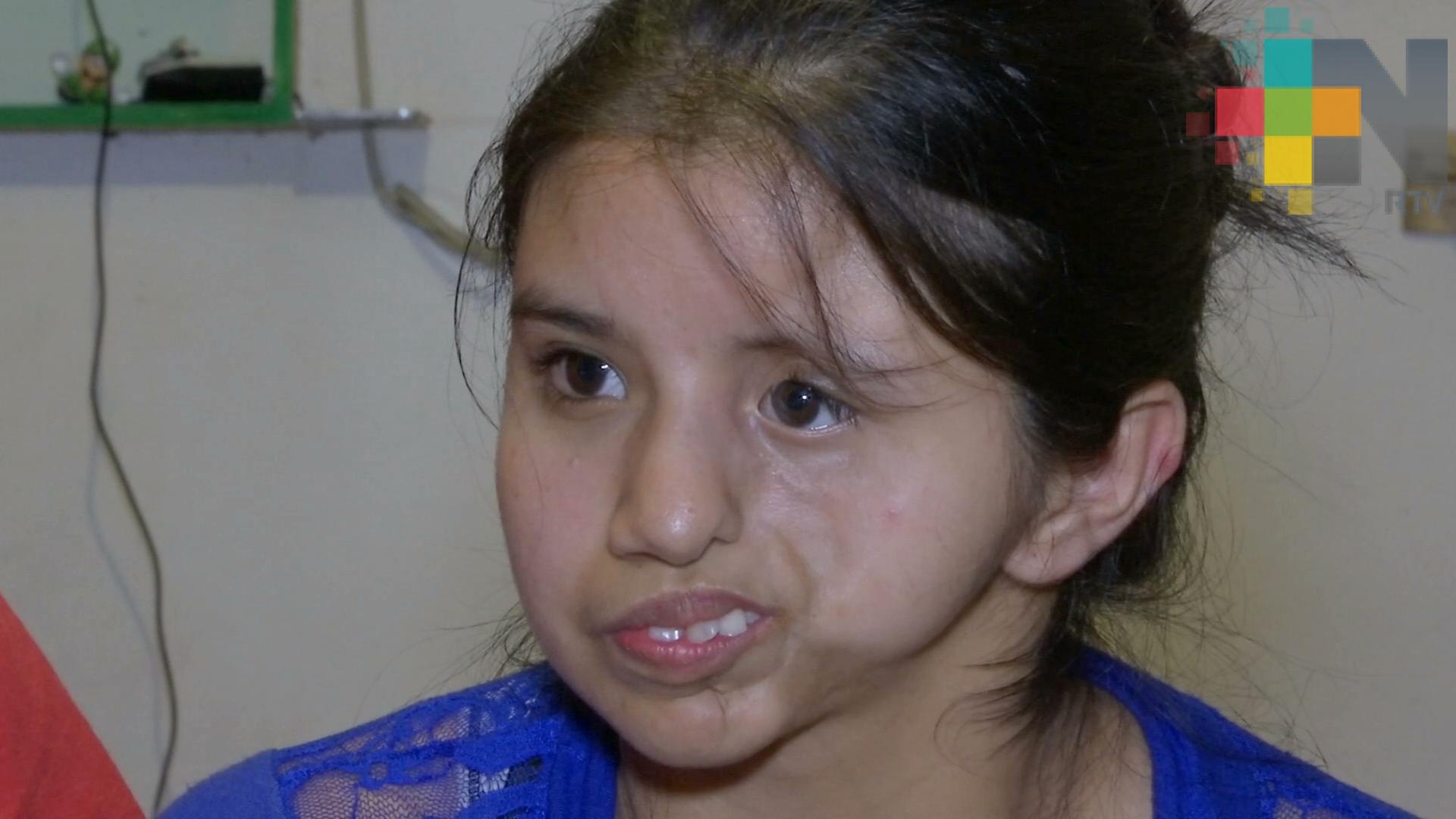 Flor, la joven con Parry Romberg, recibirá cirugía reconstructiva