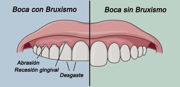 Aumenta casos de bruxismo en Veracruz-Boca del Río