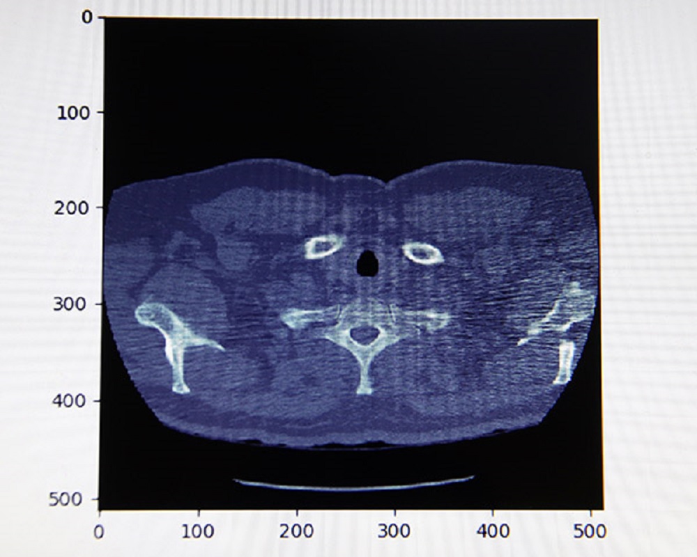 Desarrolla IPN sistema para detección de cáncer de pulmón