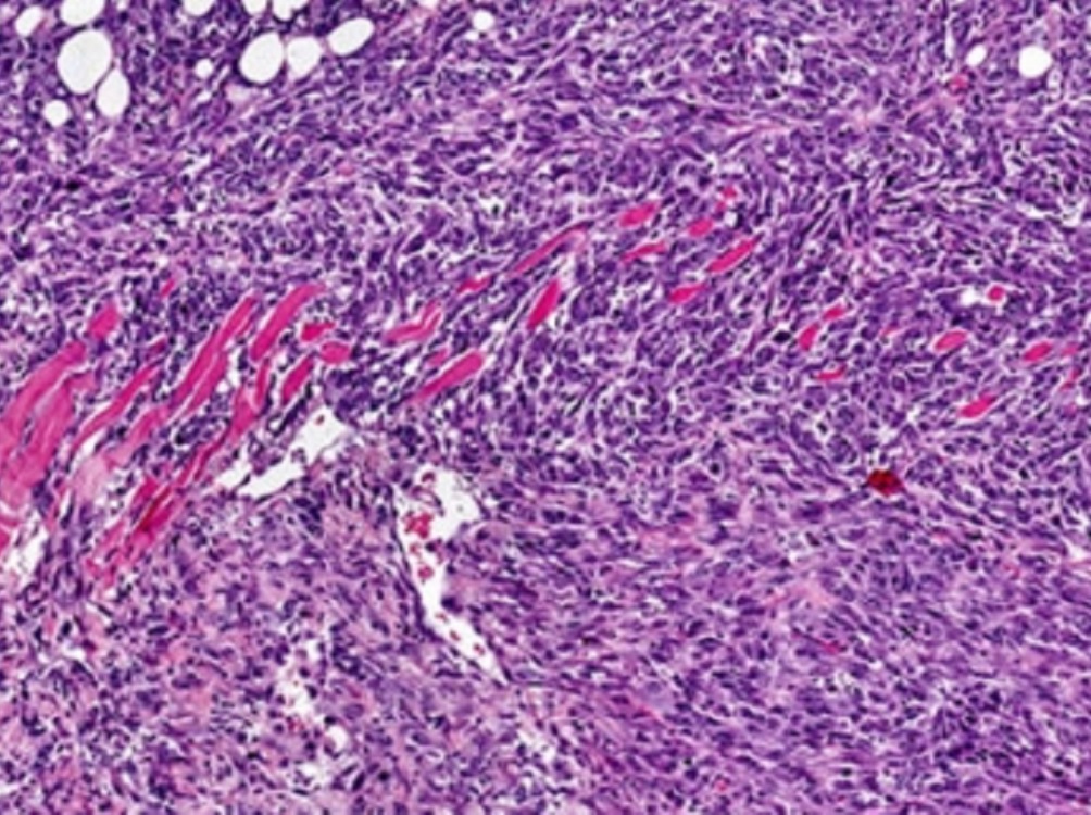 Identifican gen determinante en comportamiento de células cancerosas