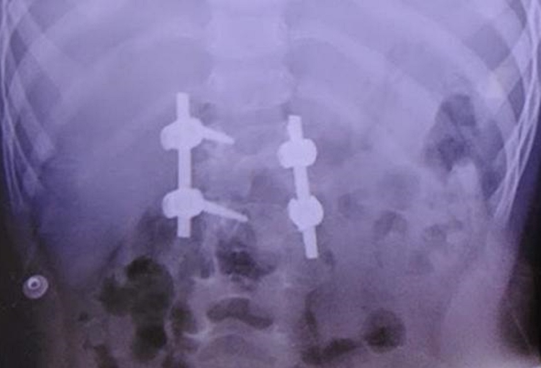 Ortopedistas del IMSS corrigen malformación de columna a niña con retiro de una vértebra
