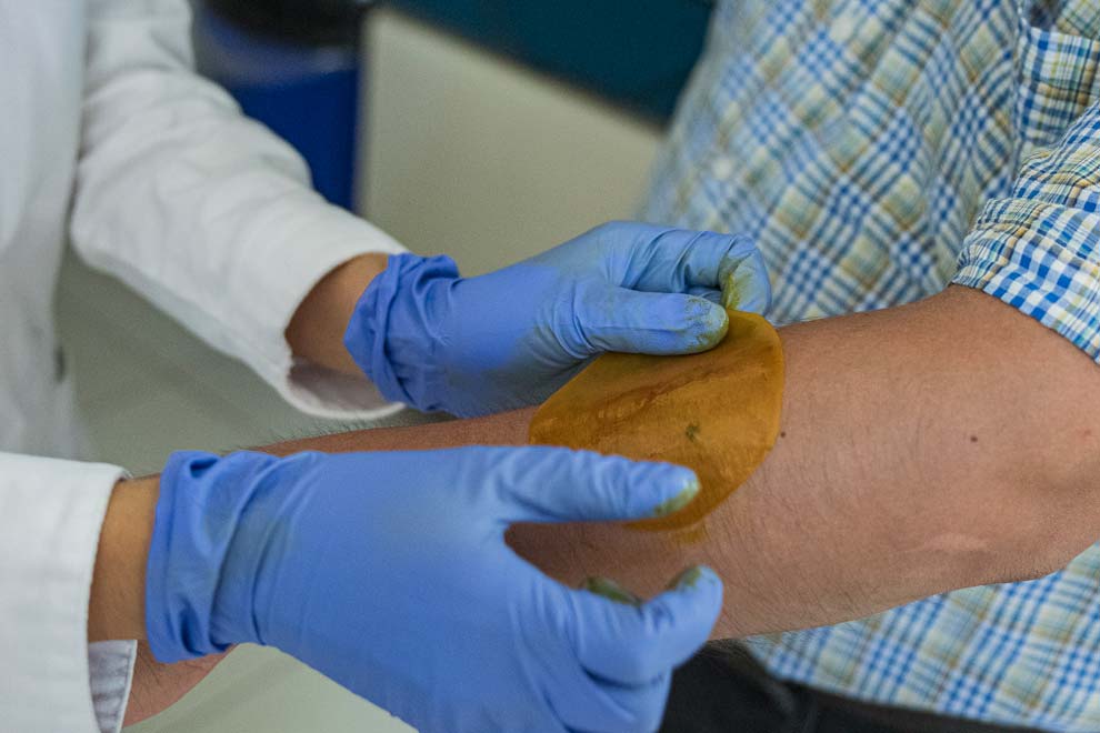 Crean en la UNAM parche biodegradable para cicatrizar quemaduras