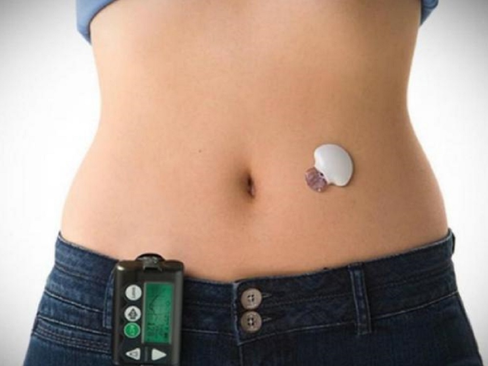 Desarrollan páncreas artificial para diabéticos