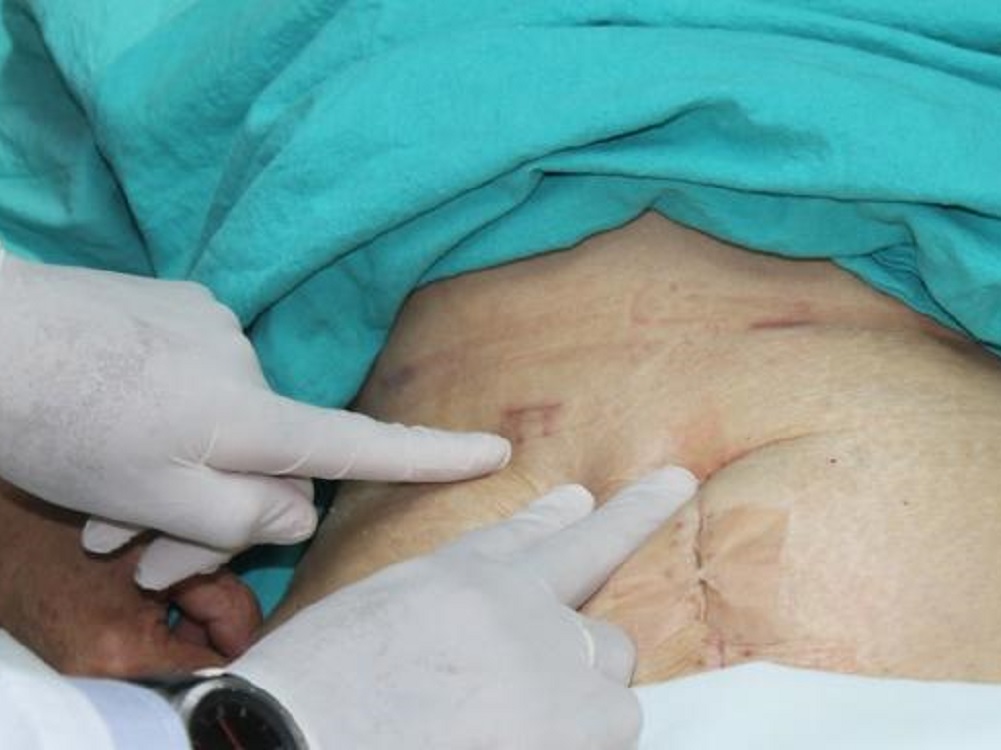 Primer caso en el país de resección de un tumor hepático gigante vía laparoscópica