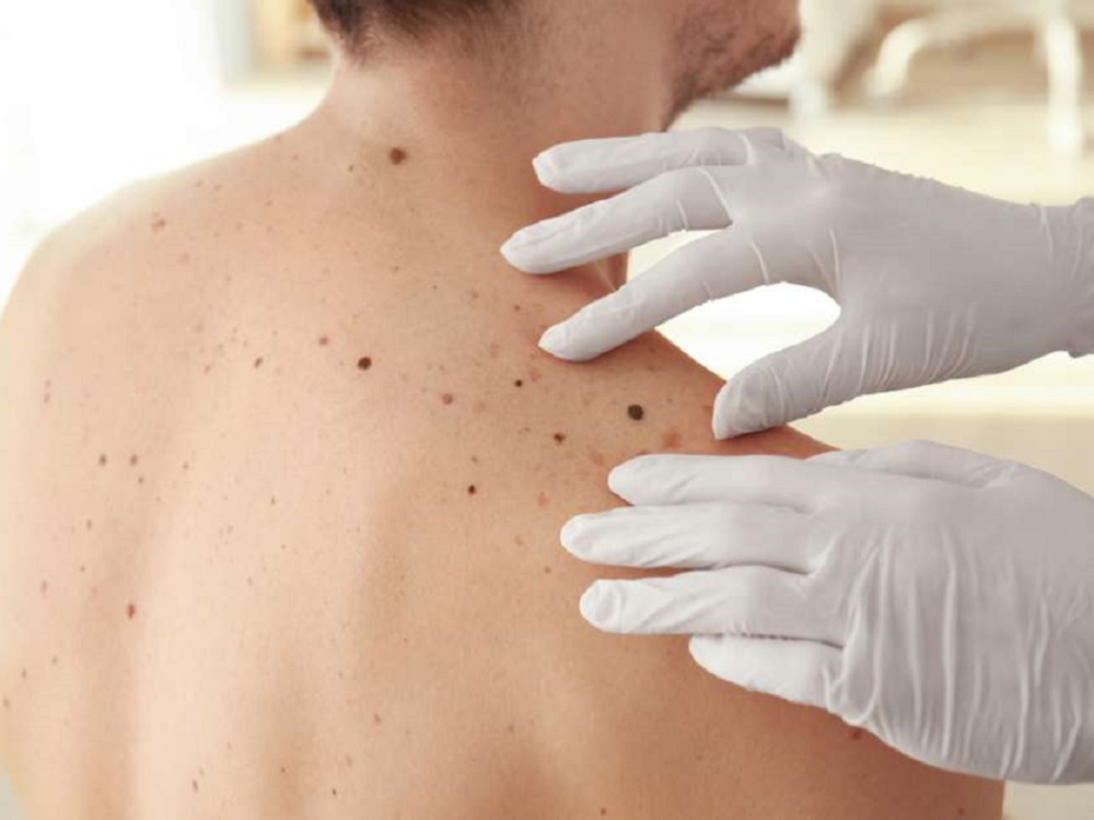 Desarrollan tratamiento para erradicar melanoma