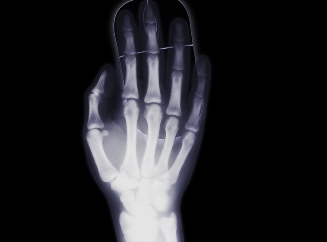 Osteoporosis afecta una de cada tres mujeres y uno de cada cinco hombres mayores de 50 años
