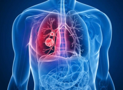 Cofepris autoriza 130 insumos para la salud destacan ensayos clínicos para tratar cáncer de pulmón y de piel