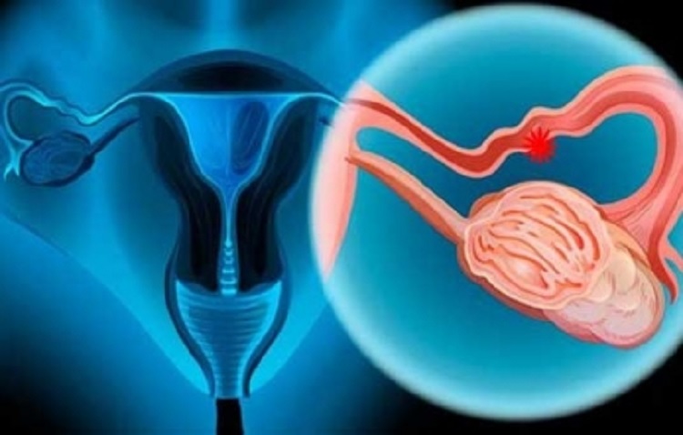 Cáncer de ovario, tercera causa de fallecimiento por tumor en mujeres