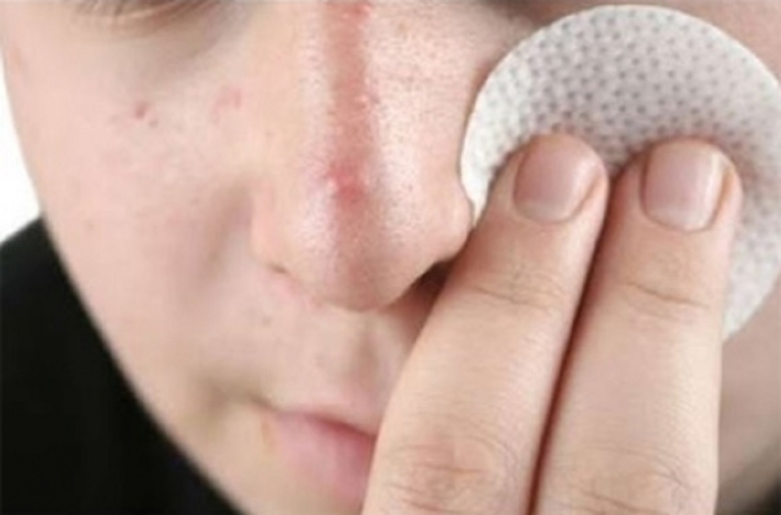 Remedios caseros agravan cuadro clínico de acné: Especialista