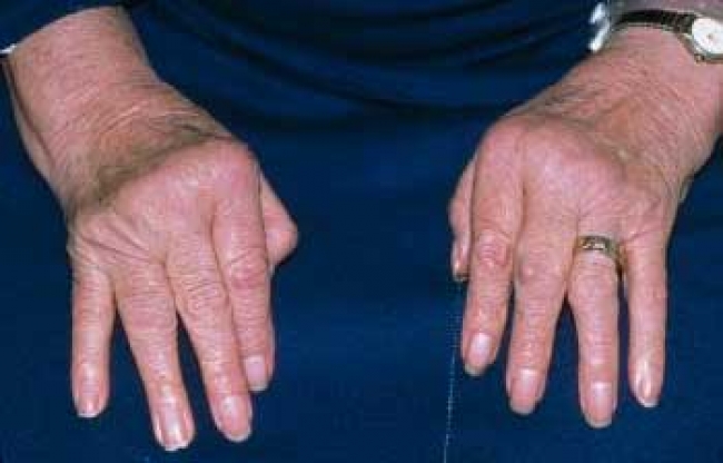 Recomiendan serie de medidas para prevenir artritis reumatoide