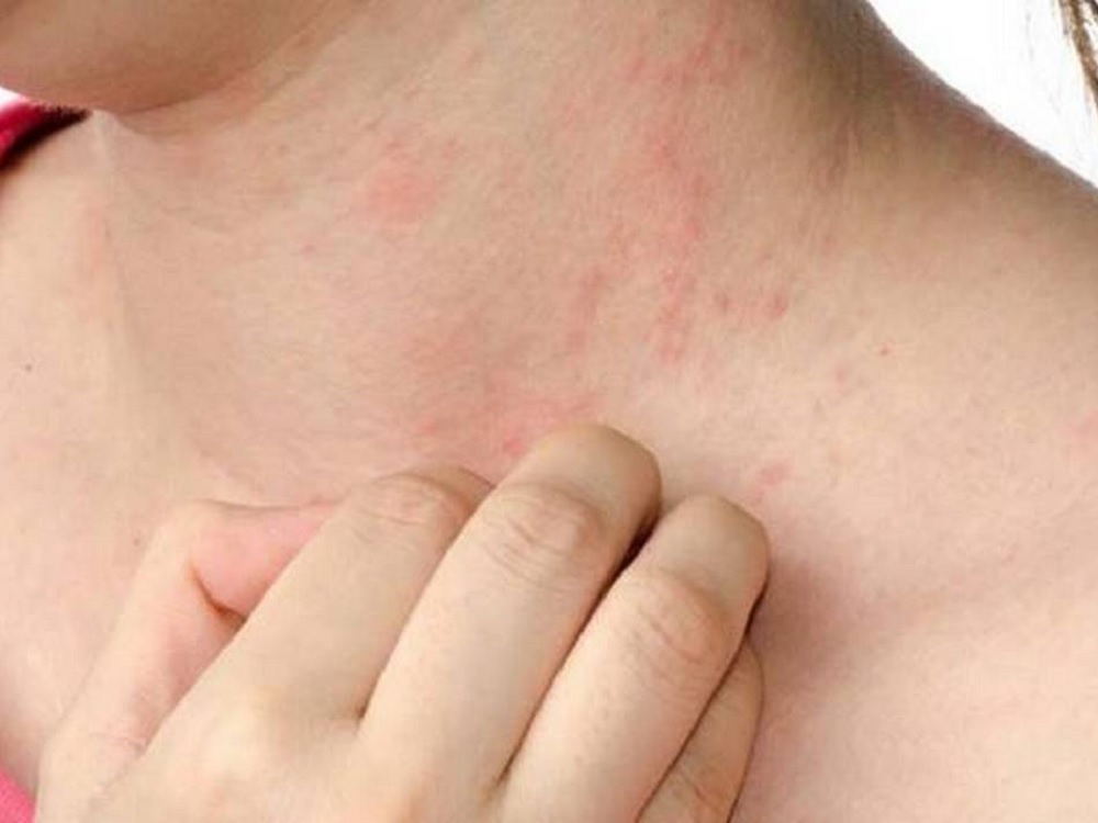 Cáncer de piel, segunda enfermedad oncológica más recurrente en México