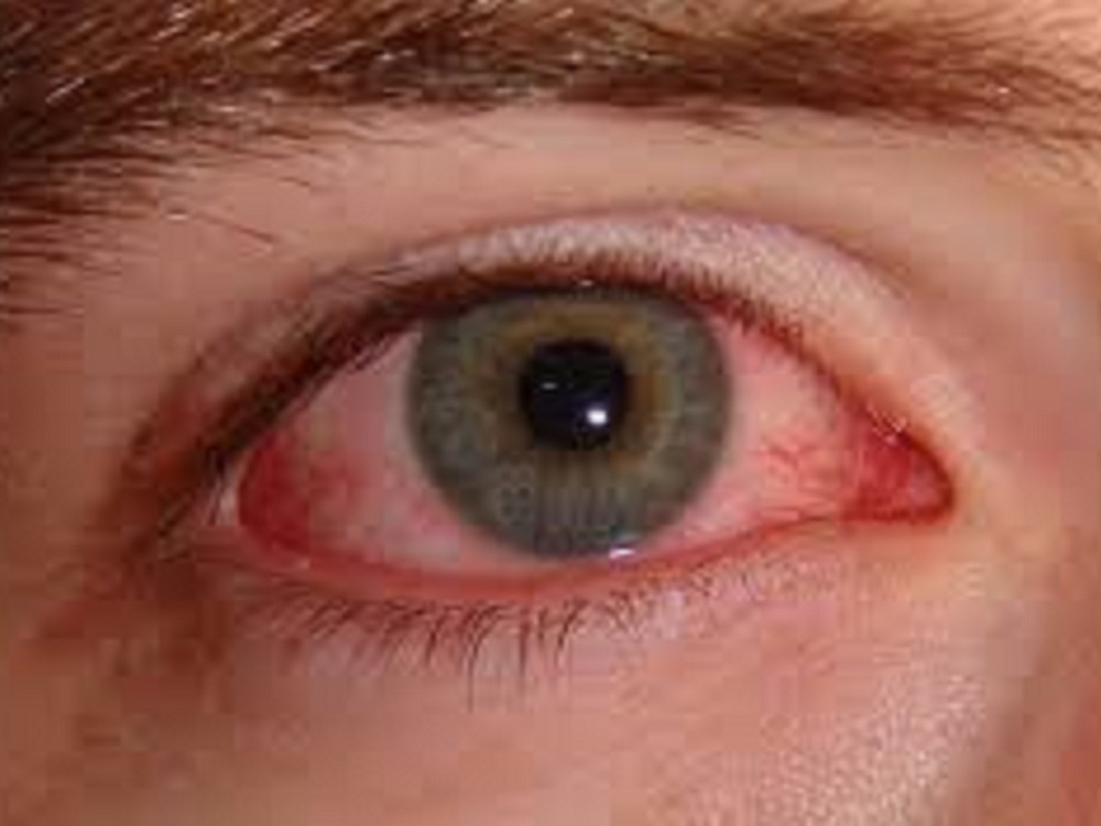Temperaturas pueden provocar aumento en el contagio de conjuntivitis