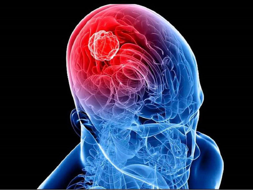 Al año, diagnostican 300 mil nuevos casos de tumores cerebrales en el mundo