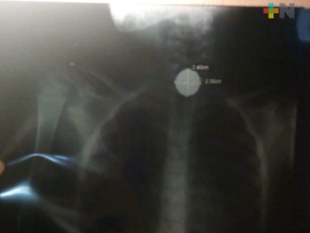 Trasladan a Hospital del puerto de Veracruz a menor que se tragó moneda