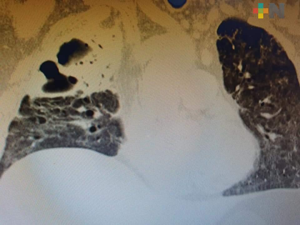 Tras dos meses de hospitalización, un hombre de 49 años venció al COVID-19