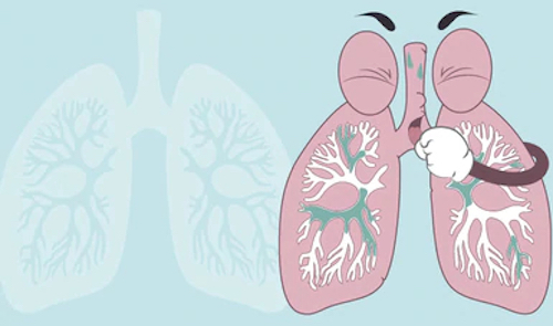Neumonía afectaba a menores de 5 años, ahora es a todos