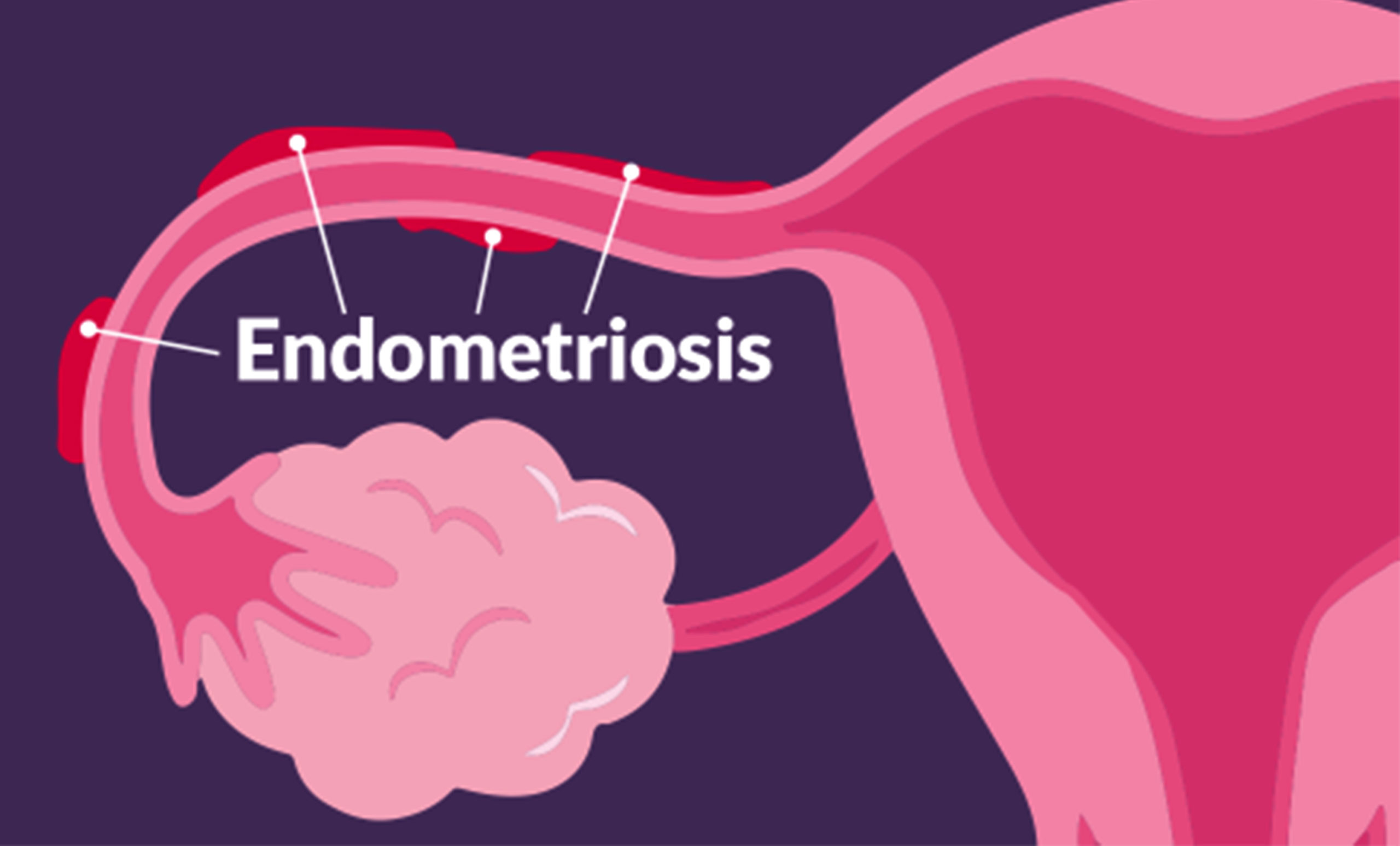 Padecimiento del útero causa dolor que puede ser incapacitante