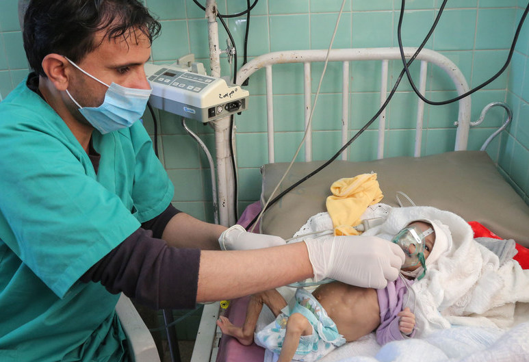 La desnutrición en Yemen pone en peligro la vida de 400.000 niños