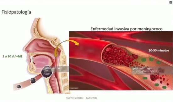 Meningitis es una enfermedad letal, pero prevenible mediante vacuna