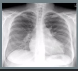 Hipertensión pulmonar puede se curable si se detecta a tiempo