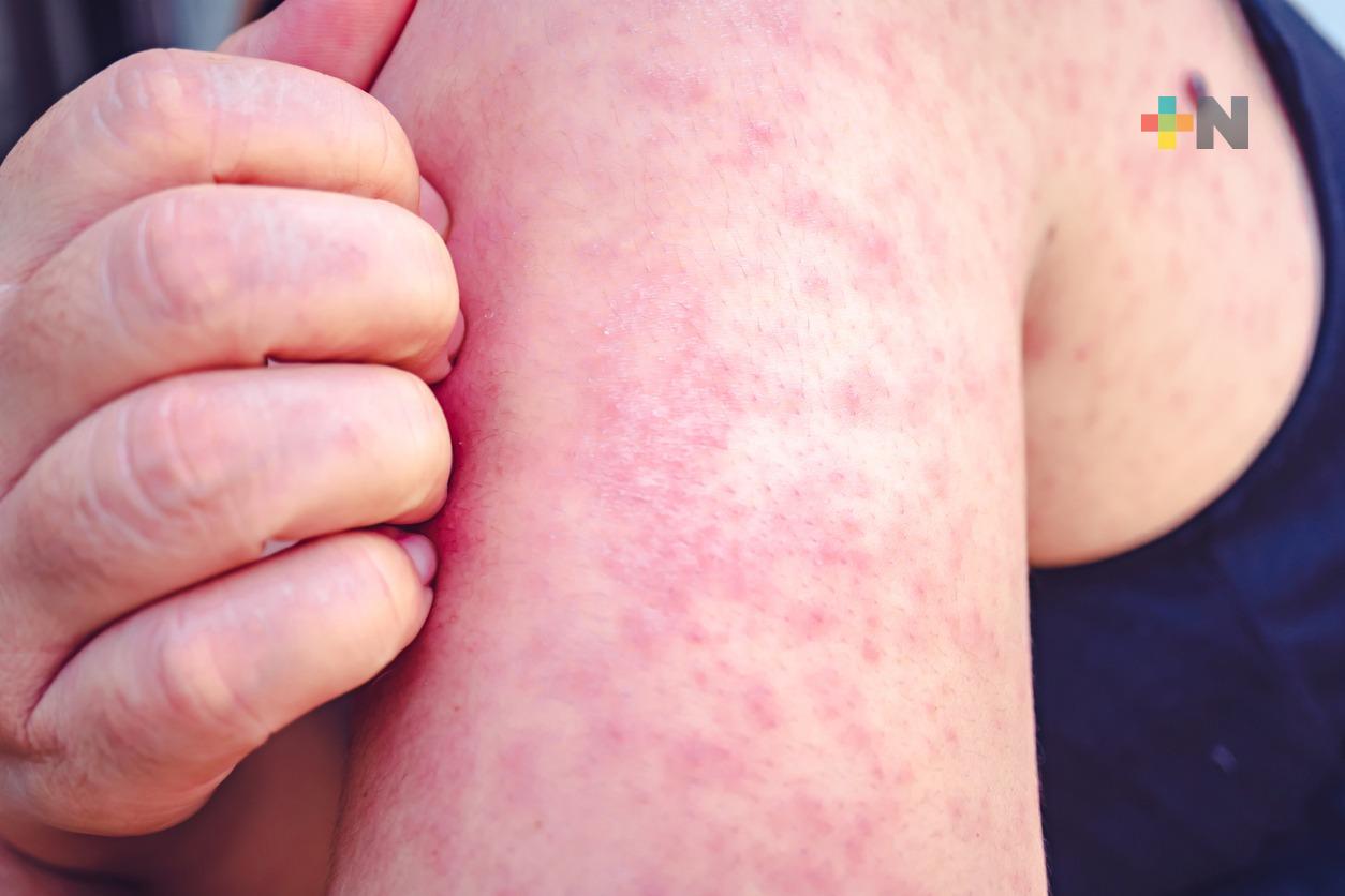 Del 19 al 25 de junio se realizará la campaña nacional de vacunación contra sarampión y rubeola en el país