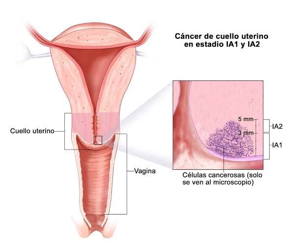 IMSS implementó programa de prevención y detección oportuna de cáncer cervicouterino