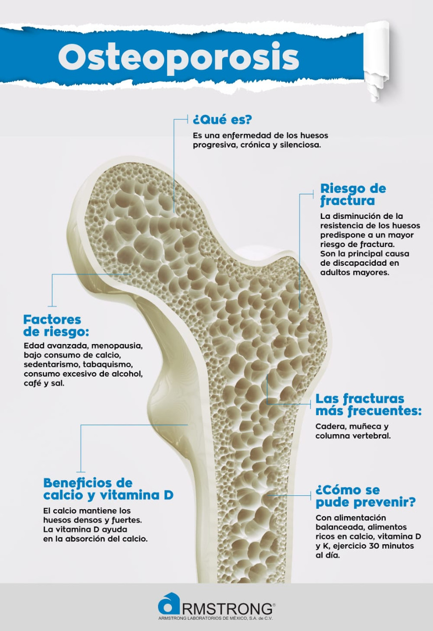 Osteoporosis, enfermedad indolora y asintomática, se puede prevenir con hábitos saludables