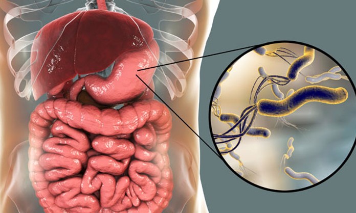 Esta bacteria puede desarrollar cáncer gástrico